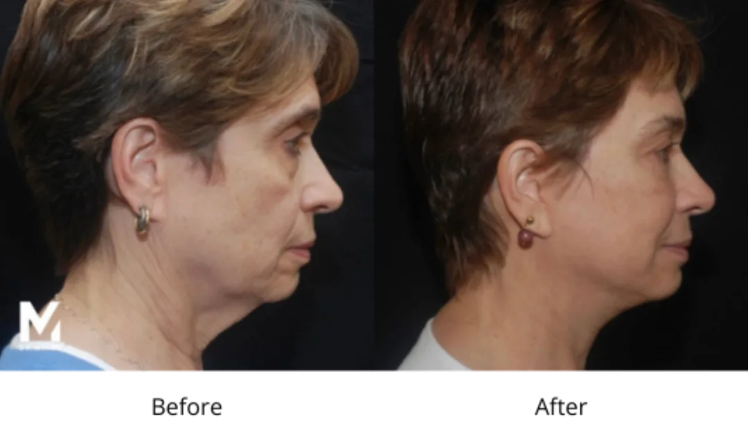 Before and after — Dr. Shoib Myint