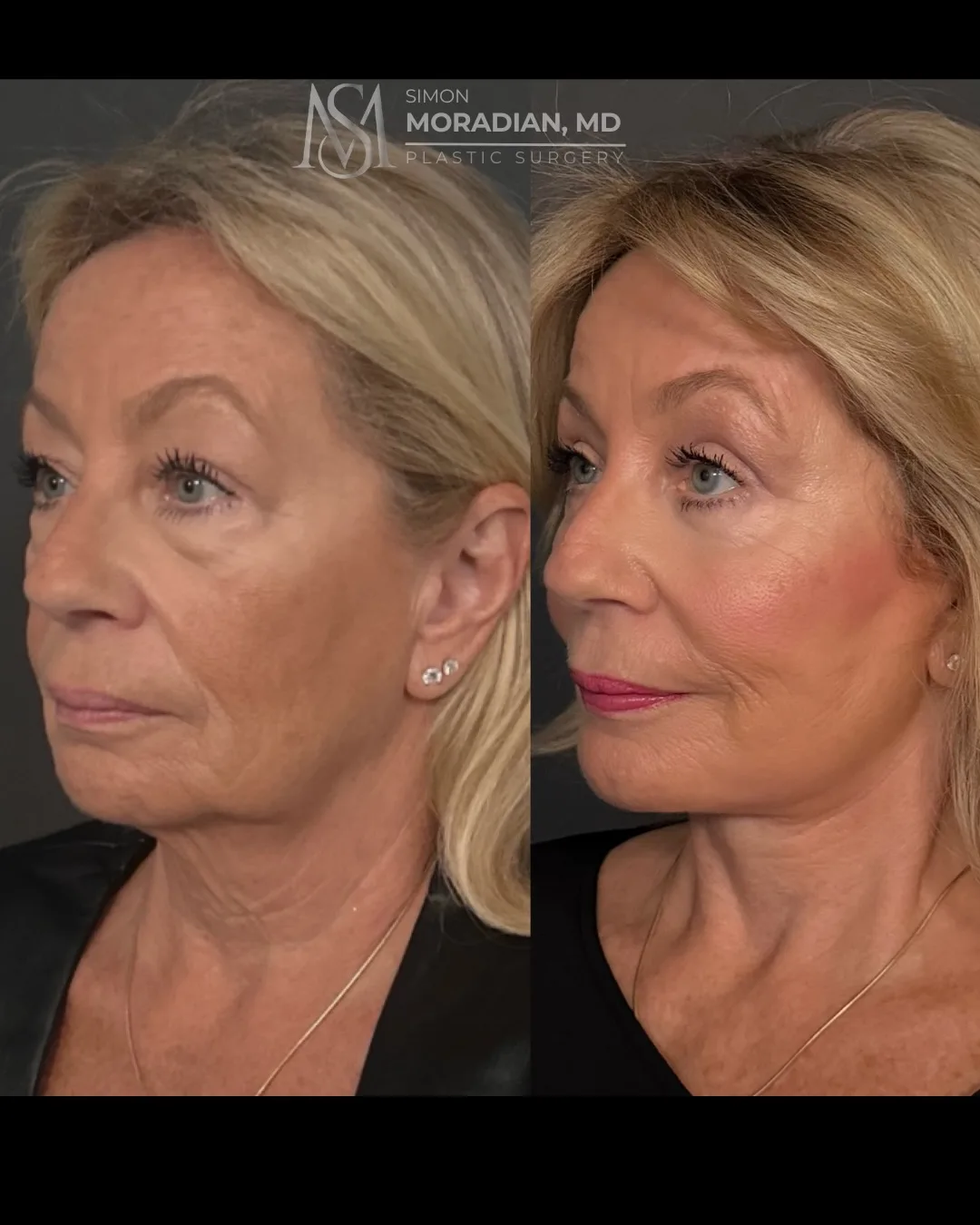 Before and after deep plane facelift — 64-year-old woman, three-quarter view, 6mo post-op by Dr. Simon Moradian