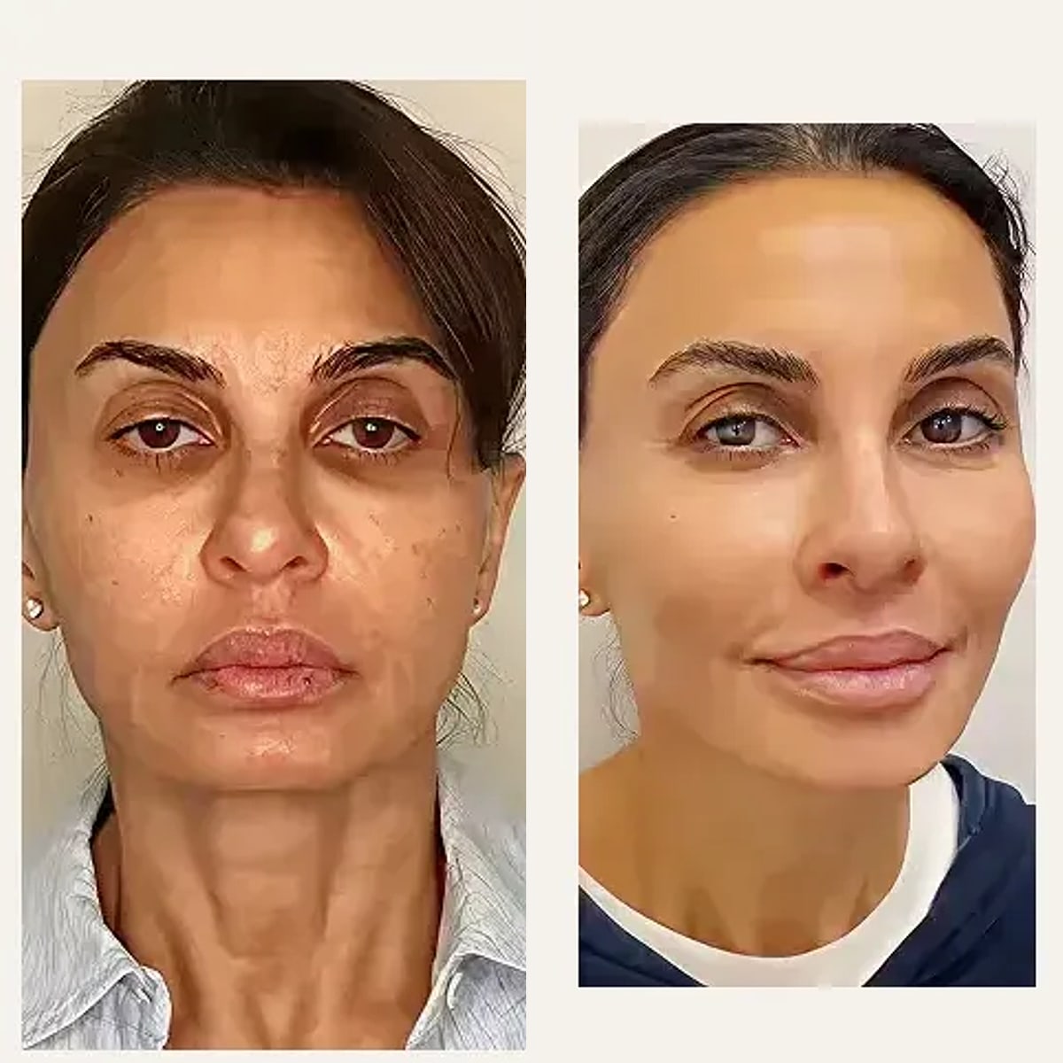 Before and after: Dr. Simon Ourian