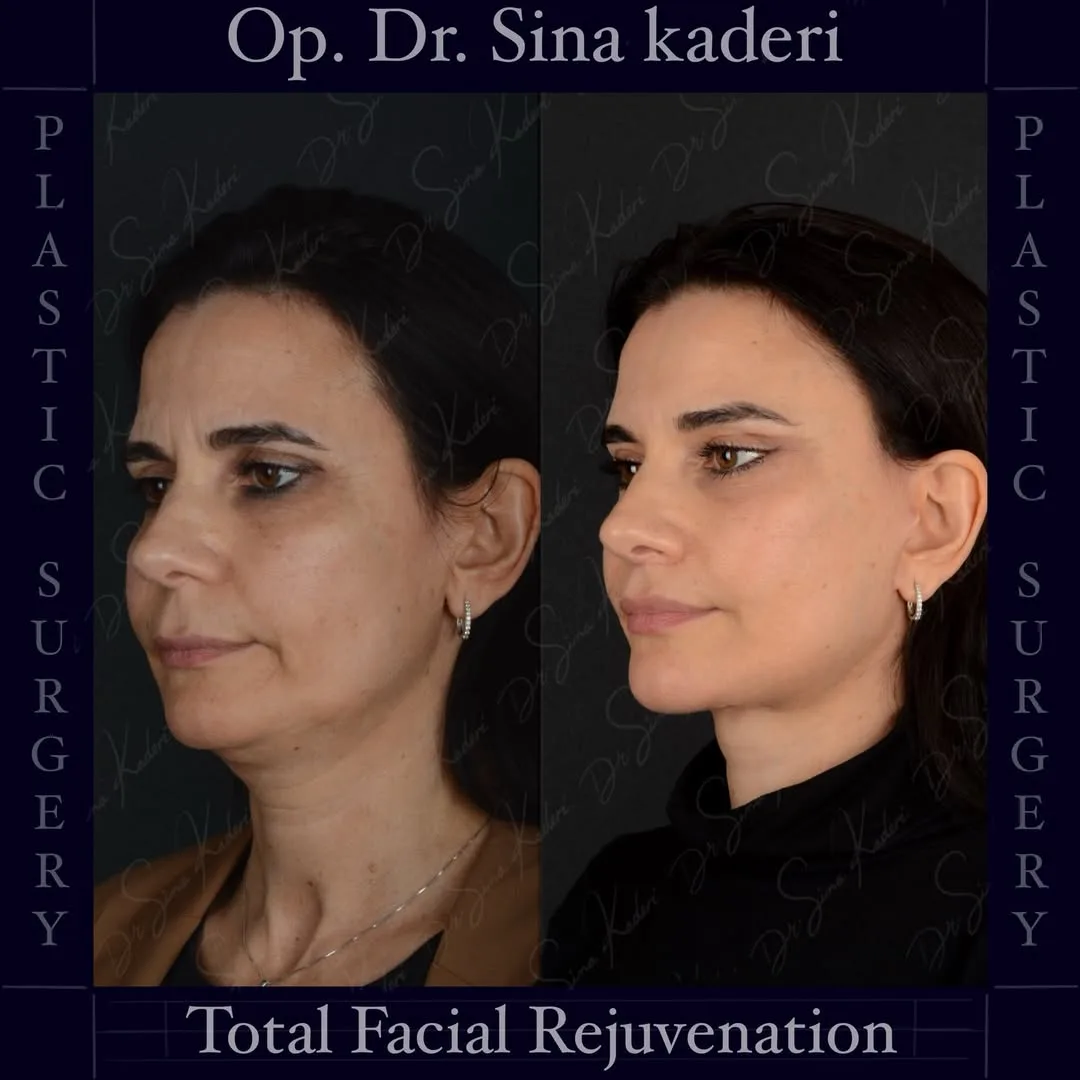 Before and after deep plane facelift — 48-year-old woman, right profile view, 7mo post-op by Dr. Sina Kaderi