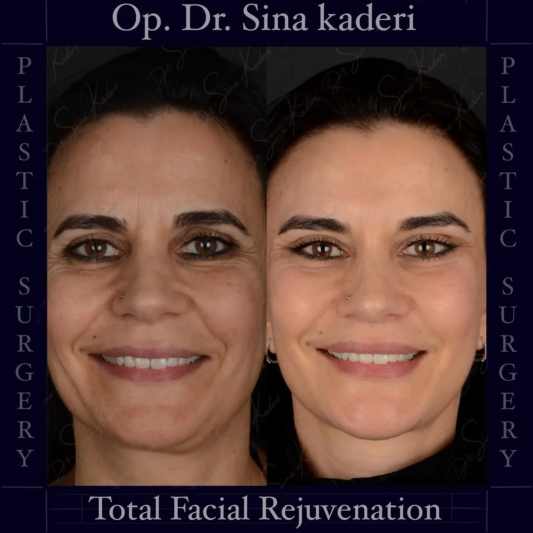 Before and after deep plane facelift — 48-year-old woman, frontal view, 12mo post-op by Dr. Sina Kaderi