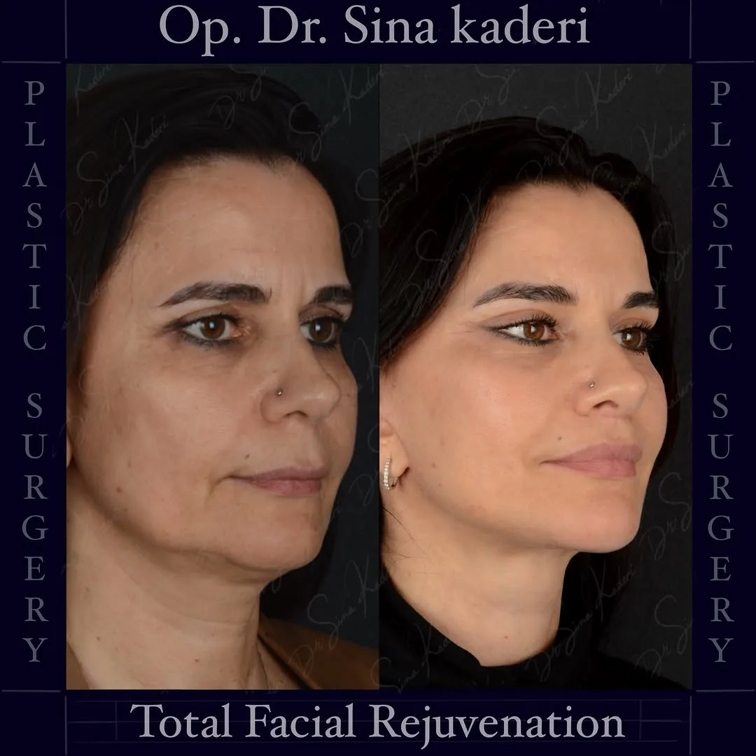 Before and after deep plane facelift — 48-year-old woman, oblique right view, 6mo post-op by Dr. Sina Kaderi