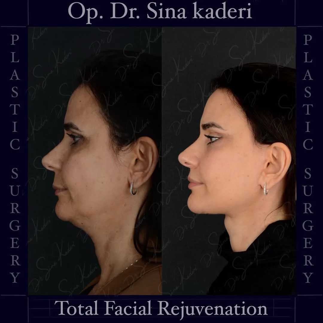 Before and after deep plane facelift — 45-year-old woman, right profile view, 9mo post-op by Dr. Sina Kaderi