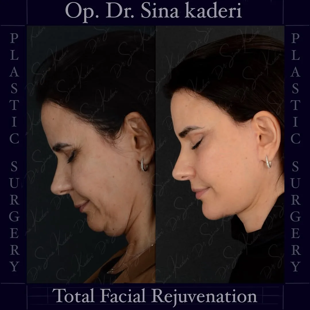 Before and after deep plane facelift — 45-year-old woman, oblique right view, 12mo post-op by Dr. Sina Kaderi