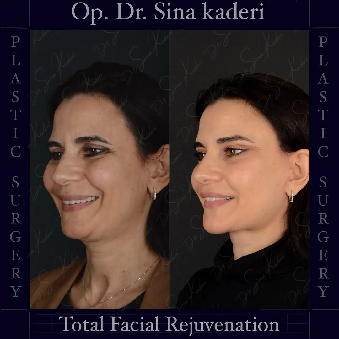 Before and after deep plane facelift — 45-year-old woman, oblique right view, 8mo post-op by Dr. Sina Kaderi