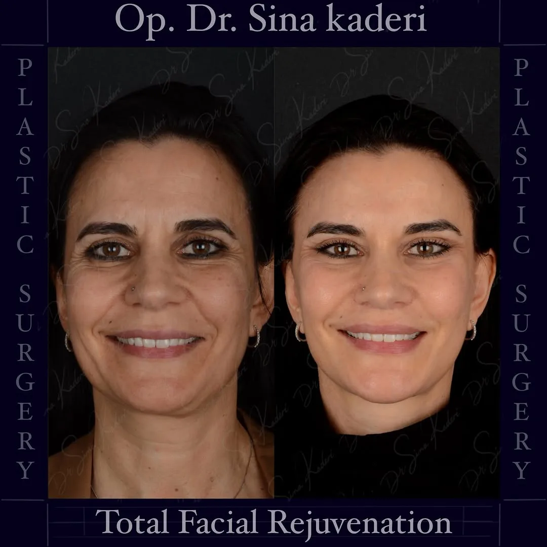 Before and after deep plane facelift — 45-year-old woman, frontal view, 7mo post-op by Dr. Sina Kaderi