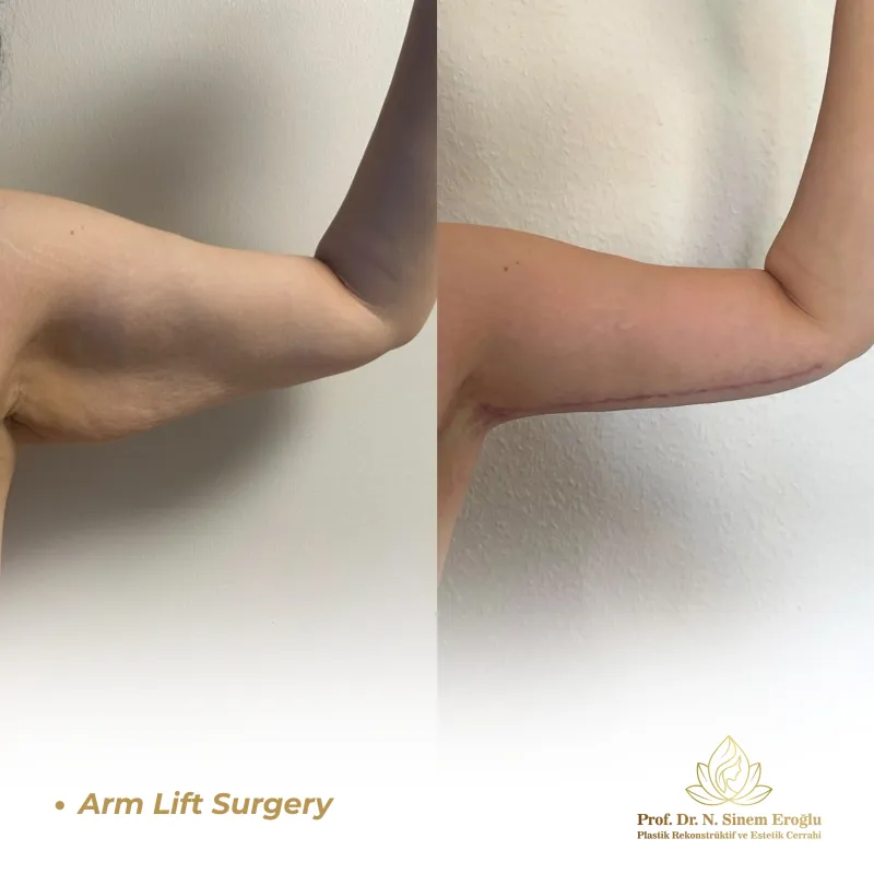 Before and after — Dr. Sinem Eroğlu