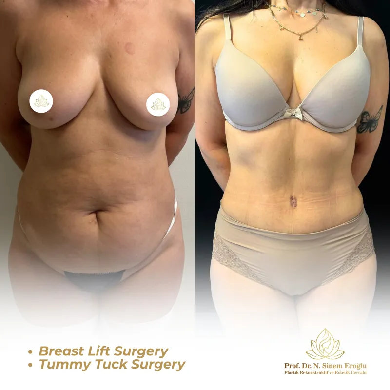 Before and after — Dr. Sinem Eroğlu
