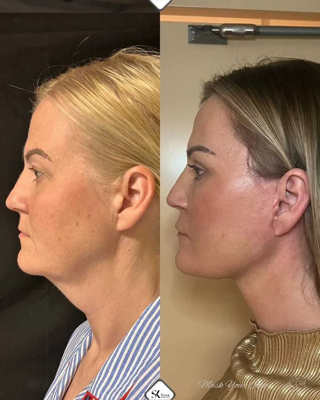 Before and after deep plane facelift — 45-year-old woman, right profile view, 6mo post-op by Dr. Soner Karaali