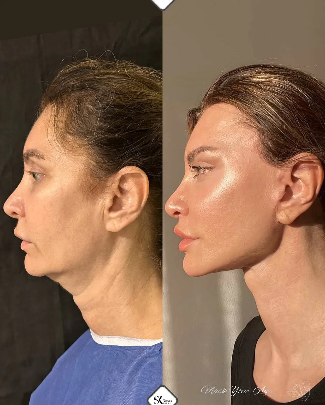 Before and after deep plane facelift — 42-year-old woman, left profile view, 6mo post-op by Dr. Soner Karaali