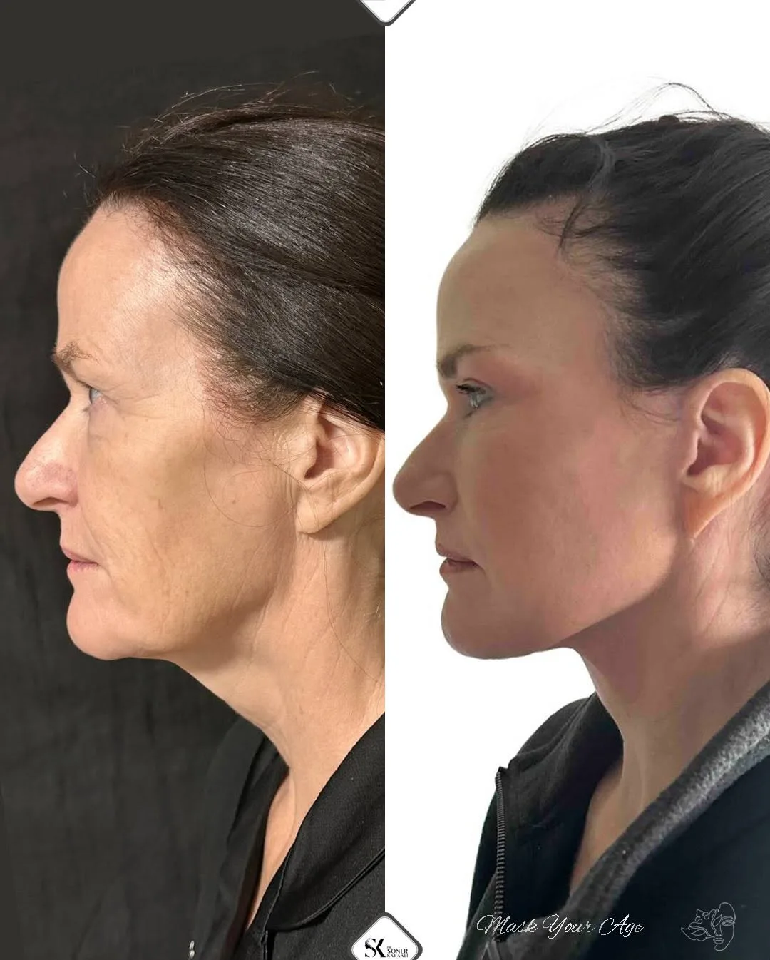 Before and after deep plane facelift — 50-year-old woman, left profile view, 6mo post-op by Dr. Soner Karaali