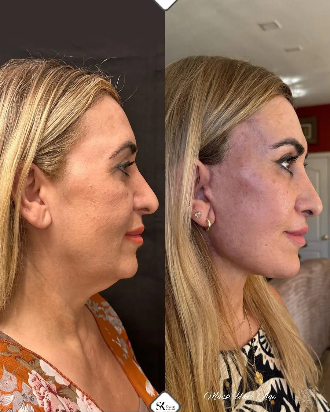 Before and after deep plane facelift — 45-year-old woman, right profile view, 8mo post-op by Dr. Soner Karaali