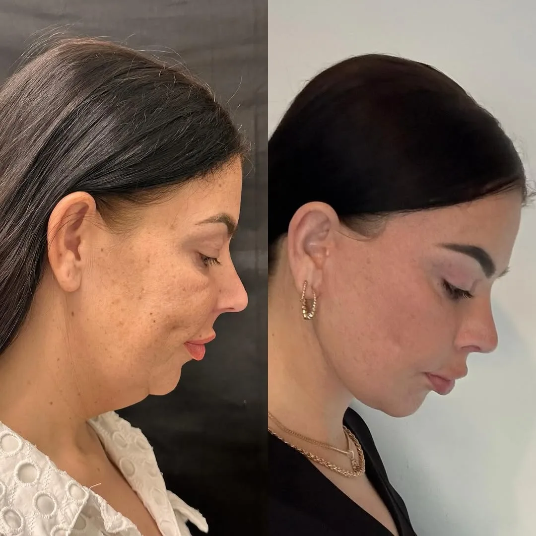Before and after deep plane facelift — 42-year-old woman, right profile view, 6mo post-op by Dr. Soner Karaali
