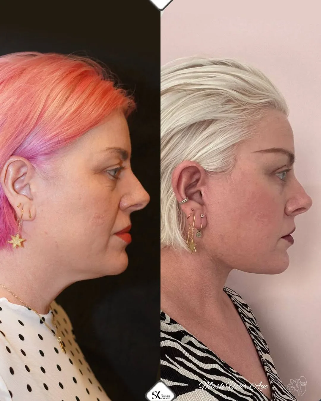 Before and after deep plane facelift — 48-year-old woman, left profile view, 9mo post-op by Dr. Soner Karaali