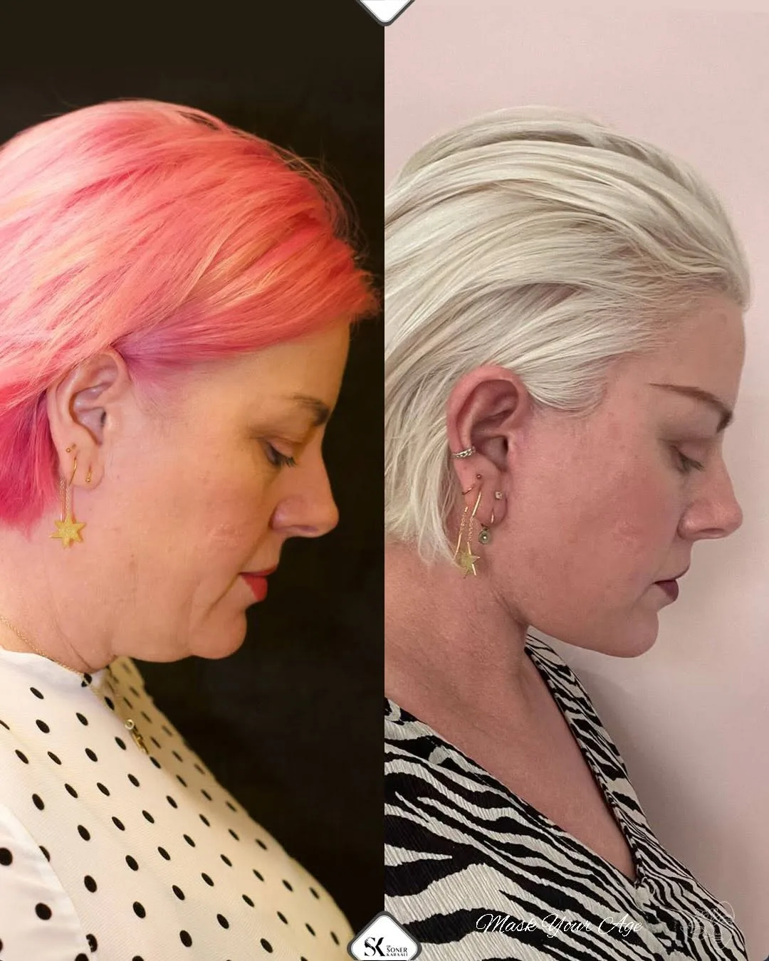 Before and after deep plane facelift — 45-year-old woman, right profile view, 7mo post-op by Dr. Soner Karaali