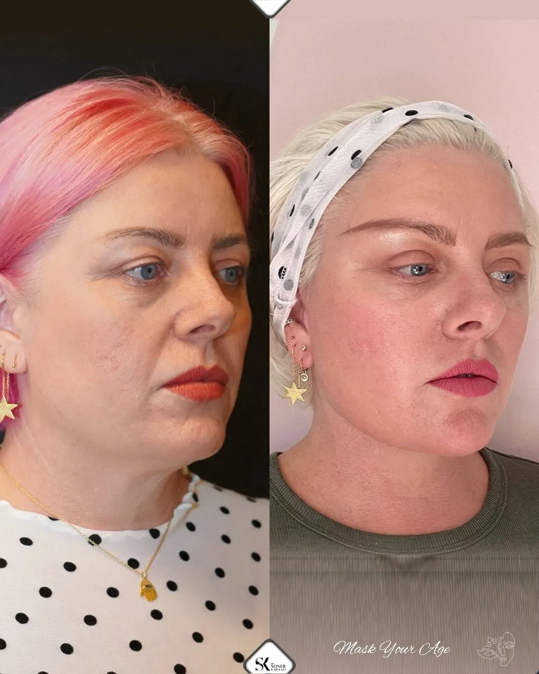 Before and after deep plane facelift — 50-year-old woman, oblique left view, 6mo post-op by Dr. Soner Karaali