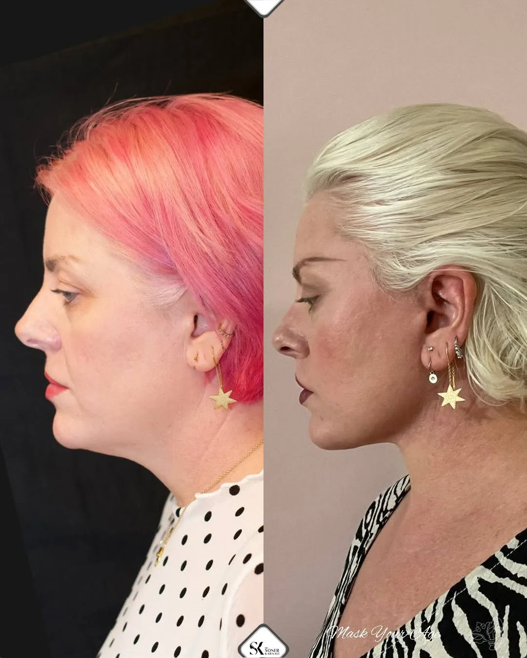 Before and after deep plane facelift — 55-year-old woman, right profile view, 9mo post-op by Dr. Soner Karaali