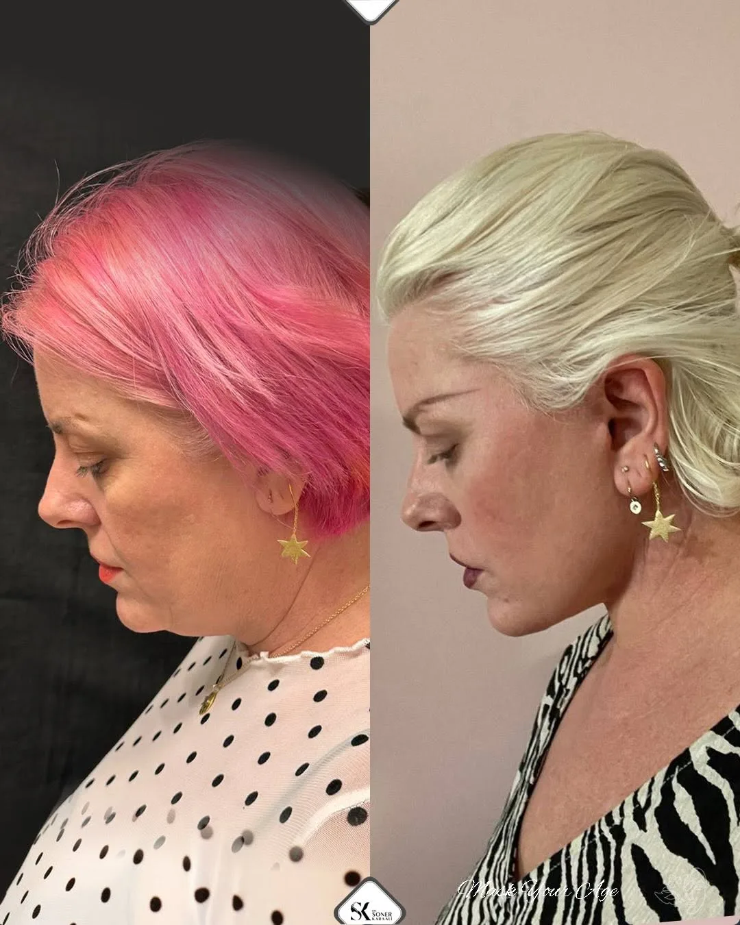 Before and after deep plane facelift — 55-year-old woman, right profile view, 7mo post-op by Dr. Soner Karaali