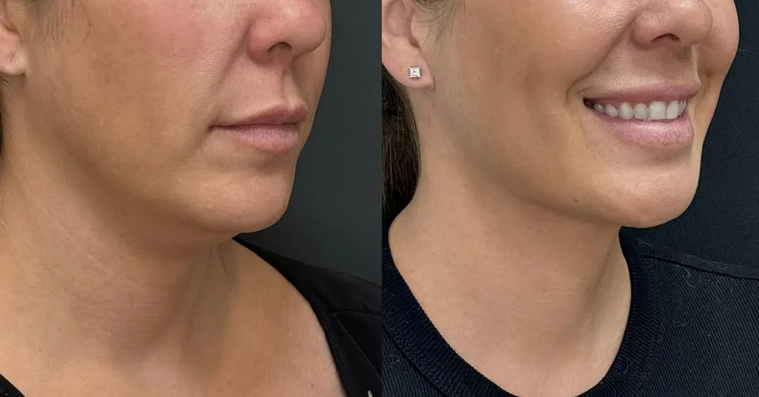 Before and after deep plane facelift — 45-year-old woman, three-quarter view, 4mo post-op by Dr. Spinder Singh