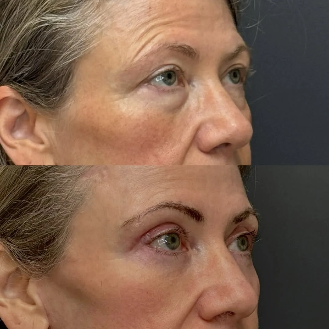 Before and after deep plane facelift — 58-year-old woman, three-quarter view, 4mo post-op by Dr. Spinder Singh