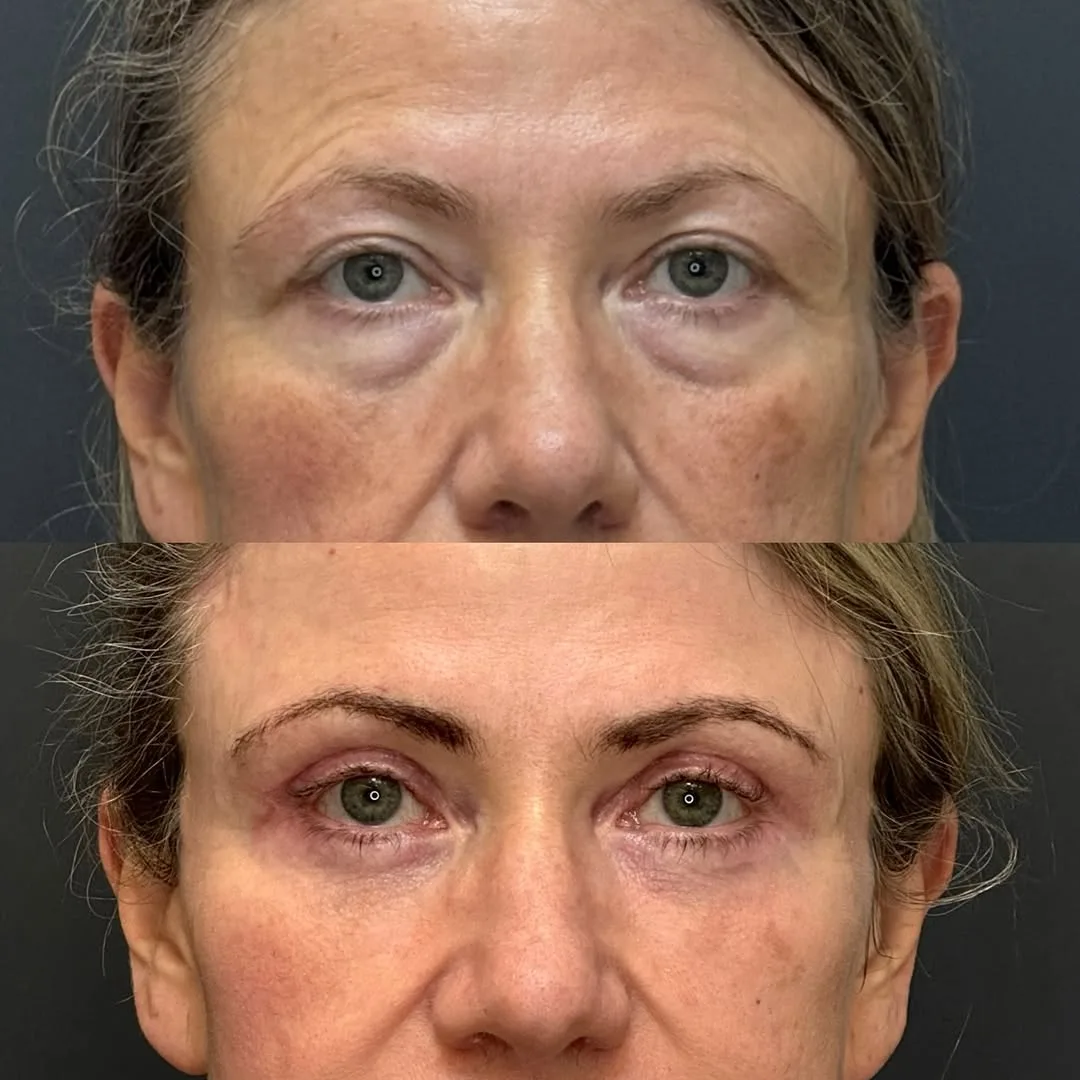 Before and after deep plane facelift — 52-year-old woman, frontal view, 4mo post-op by Dr. Spinder Singh