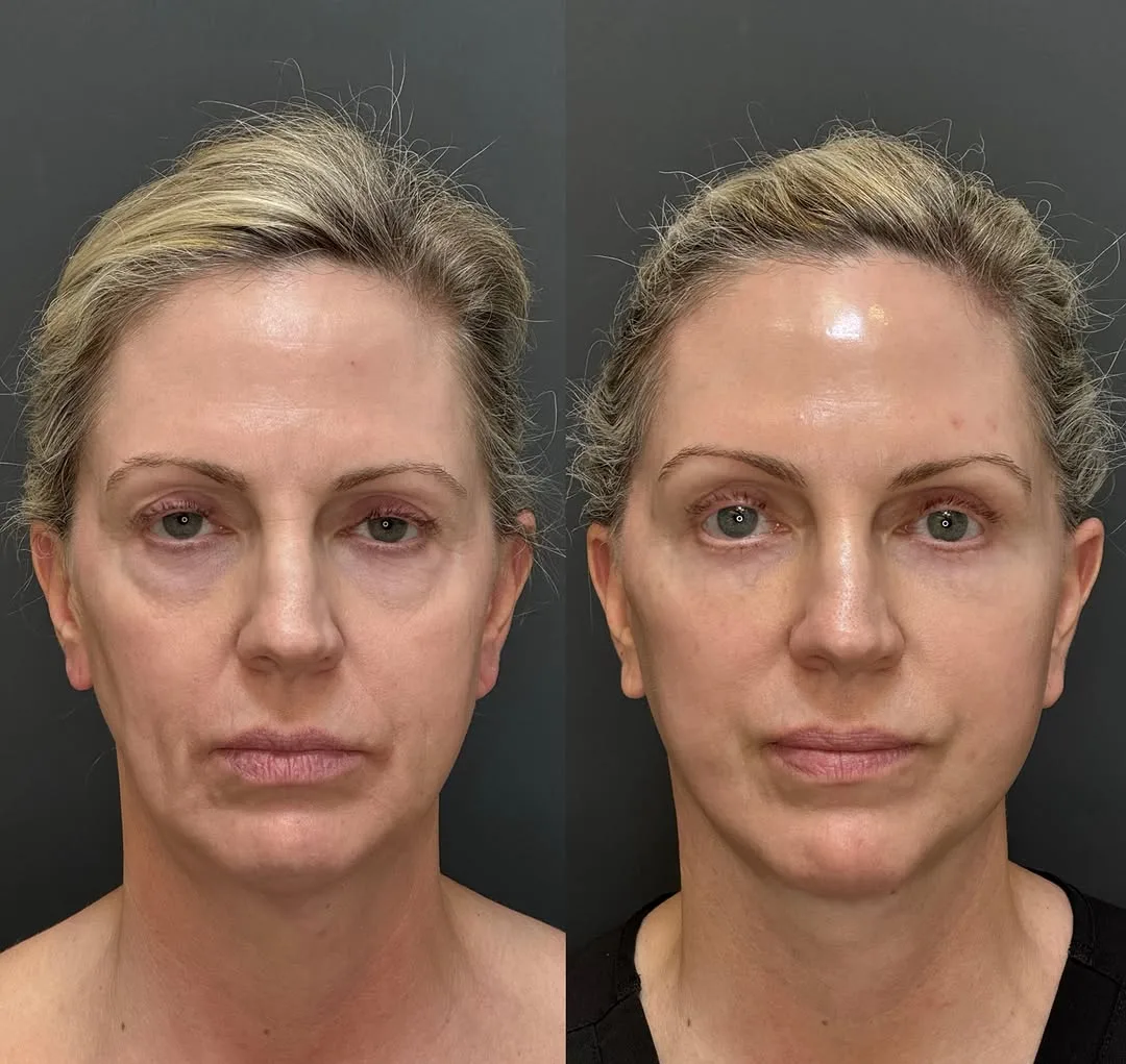 Before and after deep plane facelift — 48-year-old woman, frontal view, 6mo post-op by Dr. Spinder Singh