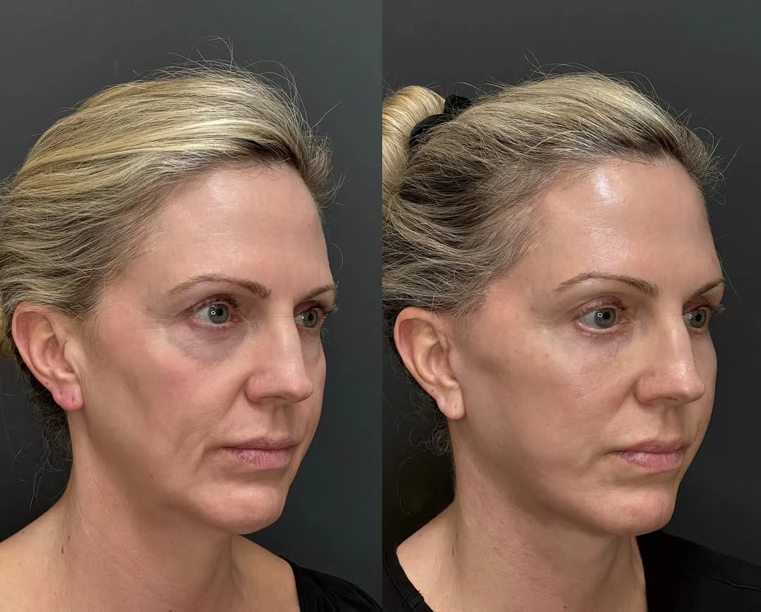 Before and after deep plane facelift — 52-year-old woman, oblique right view, 6mo post-op by Dr. Spinder Singh