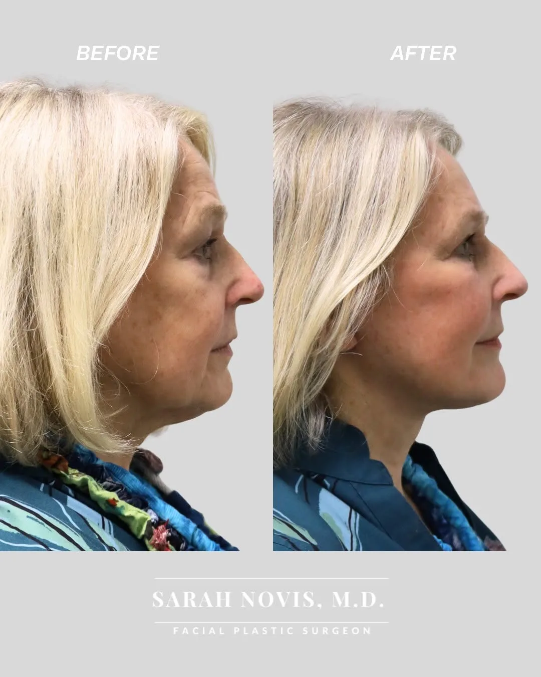 Before and after deep plane facelift — 58-year-old woman, right profile view, 5mo post-op by Dr. Stefan Novis