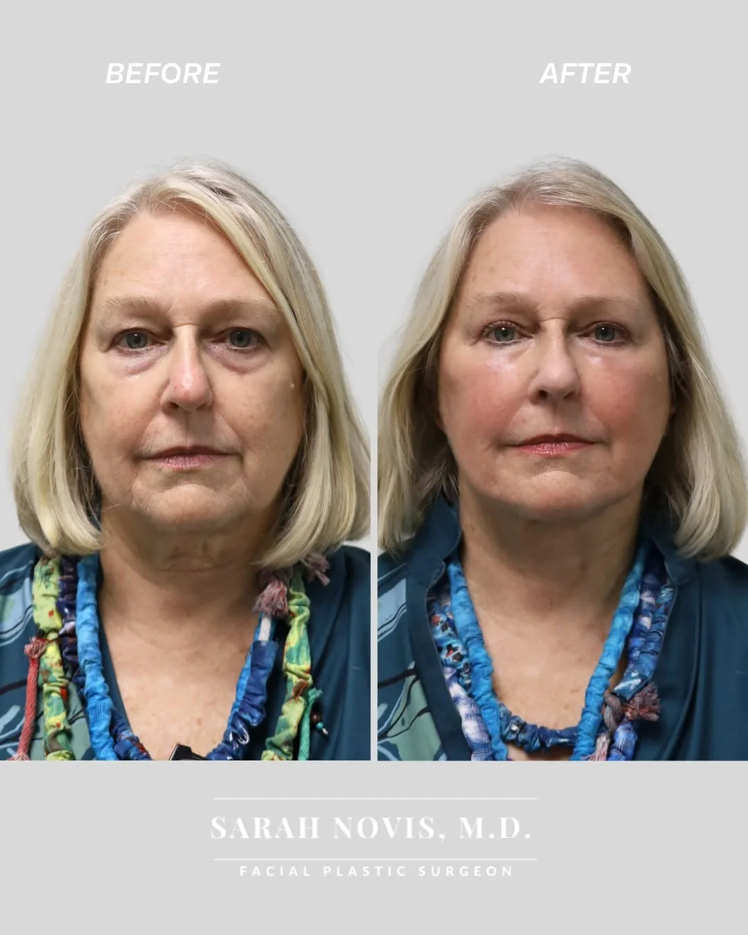 Before and after deep plane facelift — 65-year-old woman, frontal view, 5mo post-op by Dr. Stefan Novis