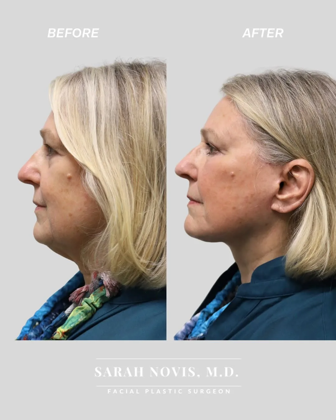 Before and after deep plane facelift — 55-year-old woman, left profile view, 5mo post-op by Dr. Stefan Novis