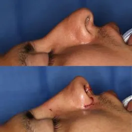 Before and after deep plane facelift — -1-year-old patient, frontal view by Dr. Stefan Shuaib