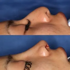 Before and after deep plane facelift — -1-year-old patient, frontal view by Dr. Stefan Shuaib
