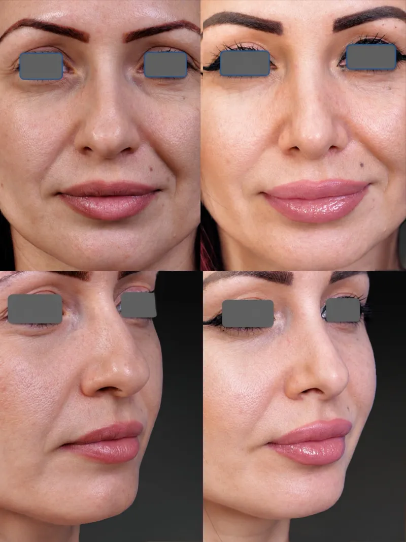 Before and after — Dr. Martin Stepanyan