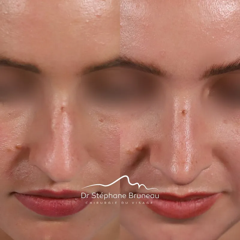 Before and after — Dr. Stéphane Bruneau