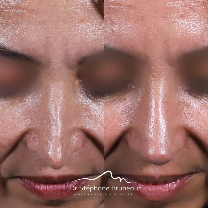 Before and after — Dr. Stéphane Bruneau