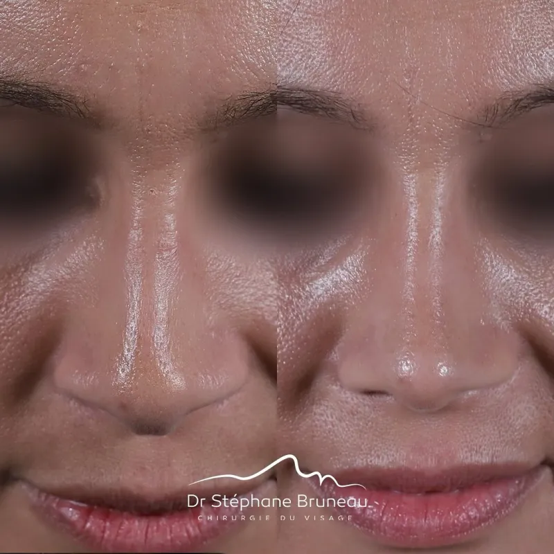 Before and after — Dr. Stéphane Bruneau