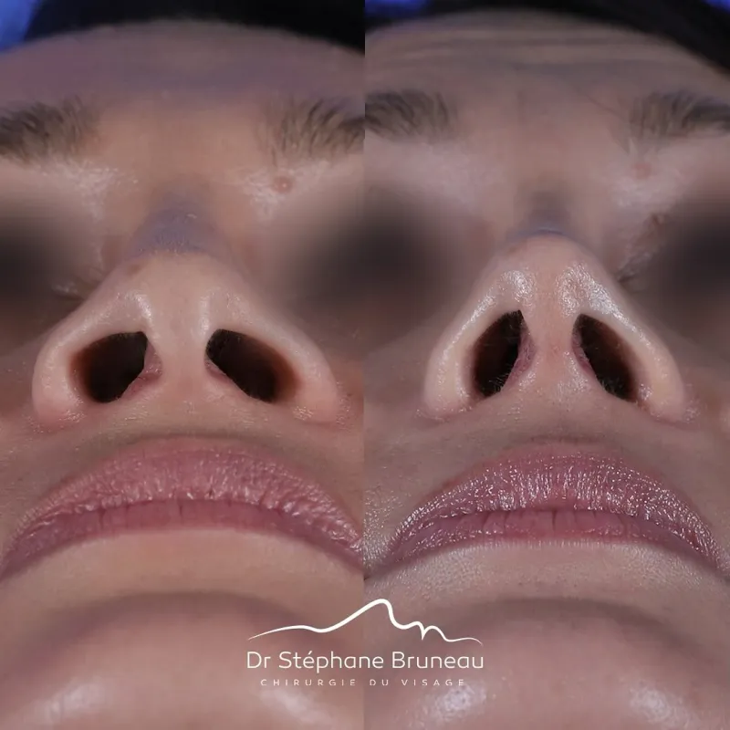 Before and after — Dr. Stéphane Bruneau