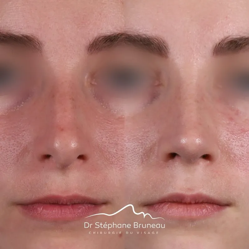 Before and after — Dr. Stéphane Bruneau