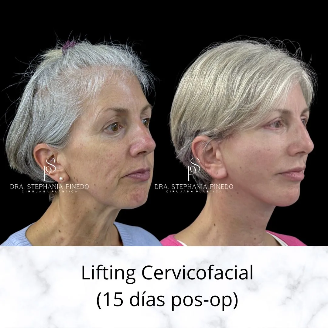Before and after — Dr. Stephania Pinedo