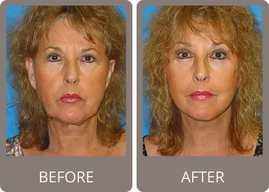 Before and after — Dr. Stephen Prendiville