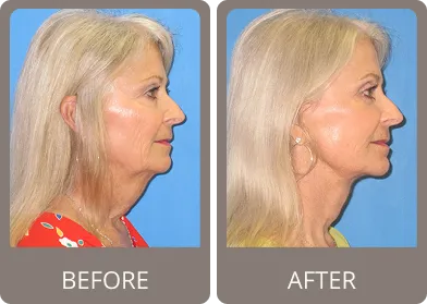 Before and after — Dr. Stephen Prendiville
