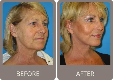 Before and after — Dr. Stephen Prendiville
