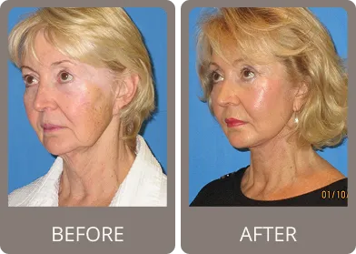 Before and after — Dr. Stephen Prendiville