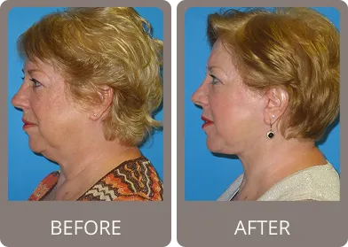 Before and after — Dr. Stephen Prendiville