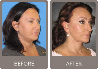 Before and after — Dr. Stephen Prendiville