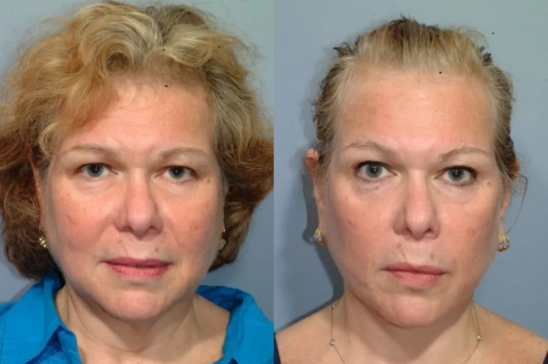 Before and after deep plane facelift — 58-year-old woman, frontal view, 7mo post-op by Dr. Steven Pearlman