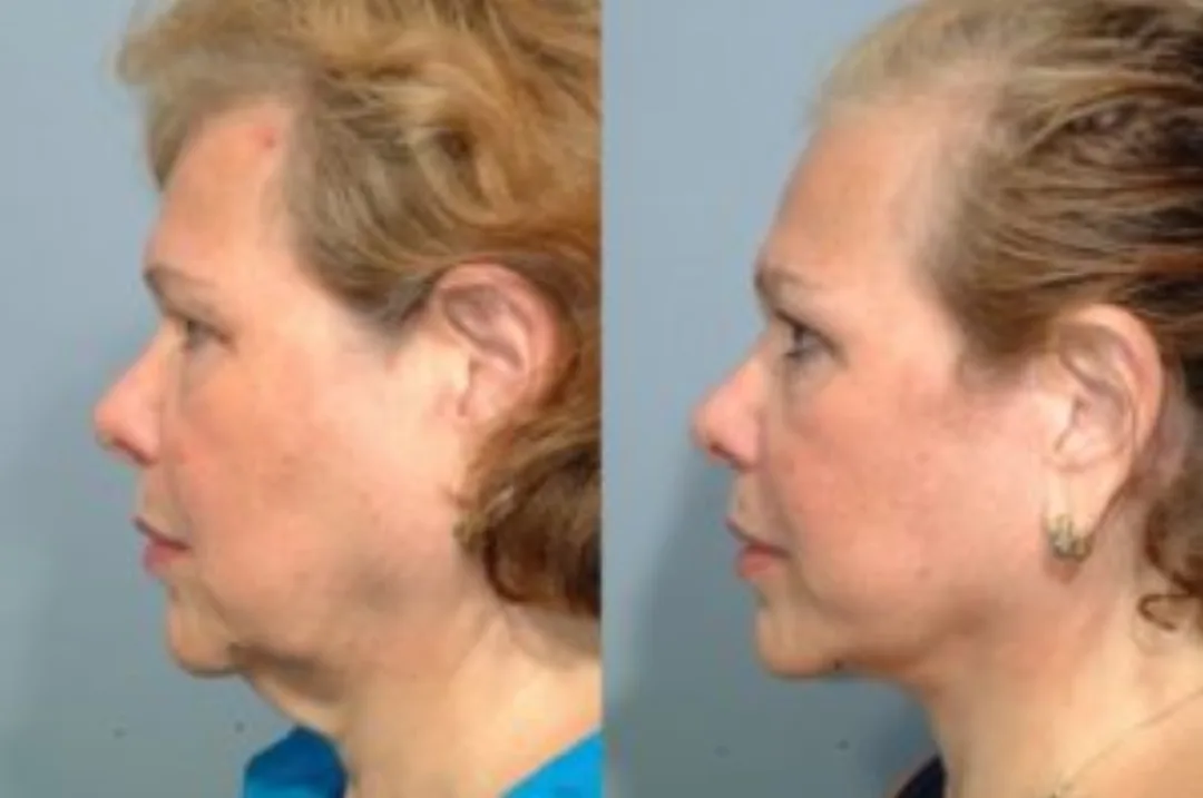 Before and after deep plane facelift — 48-year-old woman, left profile view, 6mo post-op by Dr. Steven Pearlman