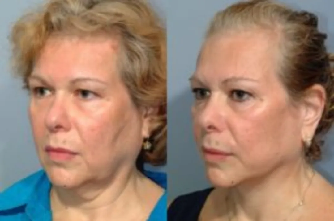 Before and after deep plane facelift — 52-year-old woman, oblique left view, 6mo post-op by Dr. Steven Pearlman
