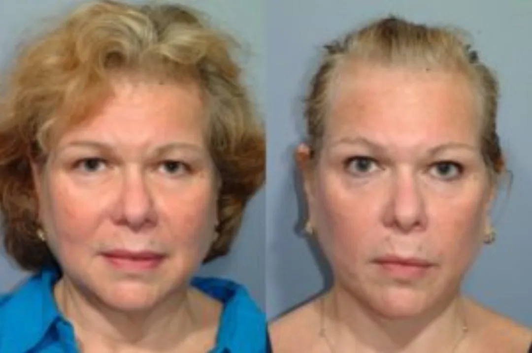 Before and after deep plane facelift — 58-year-old woman, oblique right view, 7mo post-op by Dr. Steven Pearlman