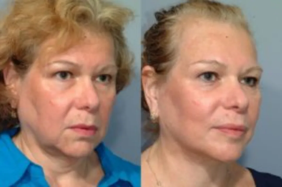 Before and after deep plane facelift — 55-year-old woman, oblique left view, 6mo post-op by Dr. Steven Pearlman